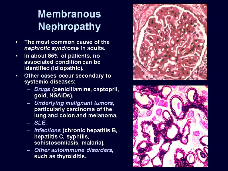 Membranous Nephropathy The most common cause of the nephrotic syndrome in adults. In about
